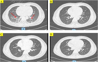 Use of trimethoprim- sulfamethoxazole for treating Pneumocystis jirovecii pneumonia in a patient with glucose-6-phosphate dehydrogenase deficiency: a case report